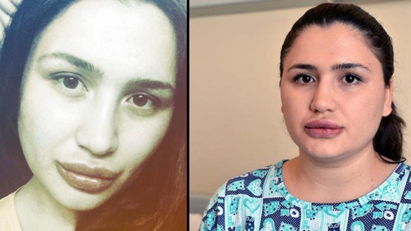 Hemşire, Dudaklarına Yeniden Kavuştu