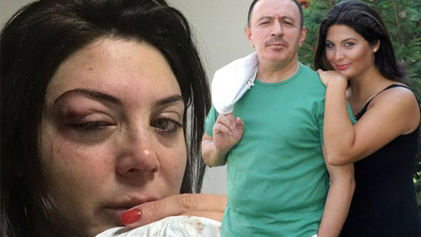 Ünlü Şarkıcının Eşi Anlattı: 'Yüzük Gözüme Oturunca Göz Kemiklerim...