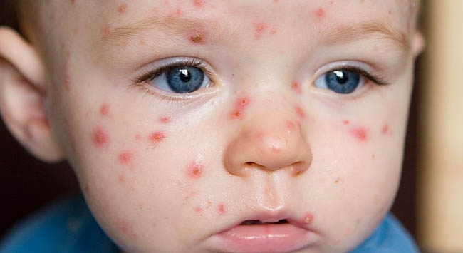 Su Çiçeği Salgını Mı Var?