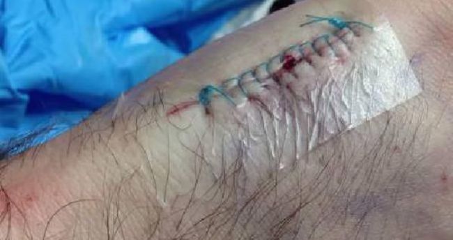 Seyahat Kartını Derisinin Altına Yerleştirdi