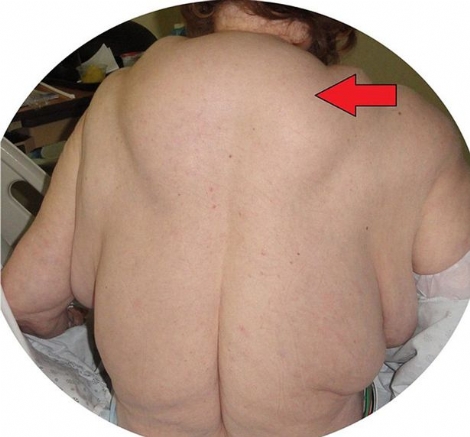 Aşırı Alkol Tüketince Sırtında Hörgüç Çıktı