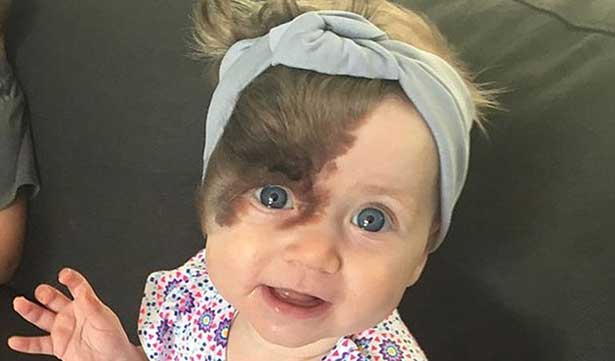 Yüzündeki Leke için 7 Ameliyat Olacak