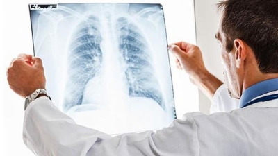 Akciğer Kanserinde Yaşam Umudu Yükseliyor