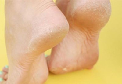 Ayak Estetiğimizi Bozan Topuk Çatlaklarından Nasıl Kurtuluruz?