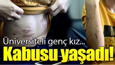 Dikkat Başınıza Gelebilir! Üniversiteli Genç Kız Lazer Epilasyon Yüzünden Kabusu Yaşadı