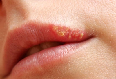 Dudak Uçuğundan Anında Kurtulmanın 3 Etkili Yolu