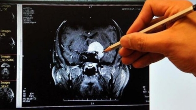 İnsanları İstenmeyen Düşüncelerden Kurtaracak Kimyasal Keşfedildi