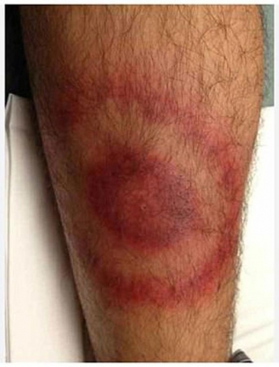 Keneler, Lyme Hastalığı Bulaştırıyor Kene Isırığı Sonrası Dikkat!!